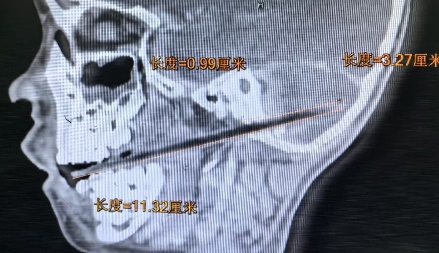 揪心，6歲男童口含麥芽糖摔倒，被竹簽刺入小腦