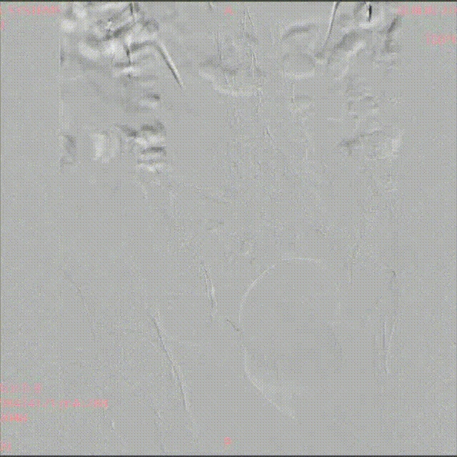 1下肢静脉造影提示左髂静脉闭塞、血流方向异常（俯卧位） 00_00_00-00_00_30.gif