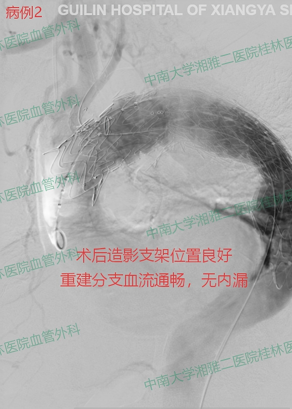 病例2-术后.png