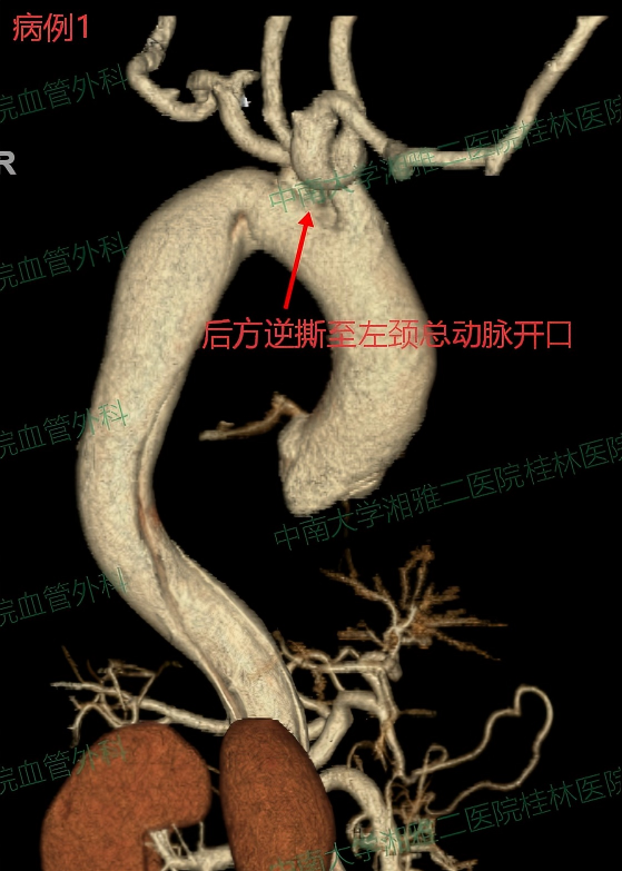 病例1-术前2.png