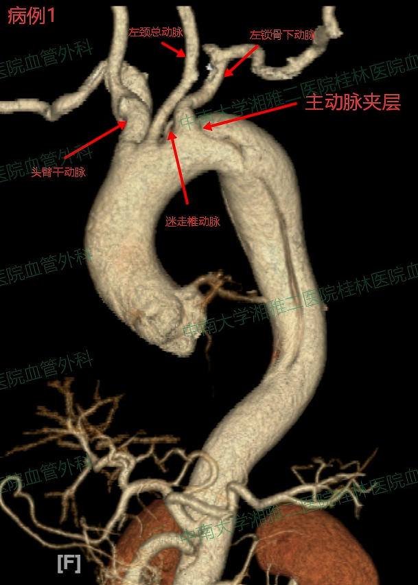 病例1-术前1.png