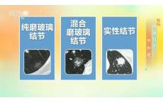 体检查出肺结节，会发展成肺癌吗？出现这些特征要警惕
