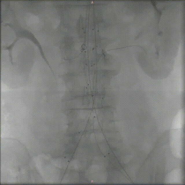 10月30日 邓先生（术后）.gif