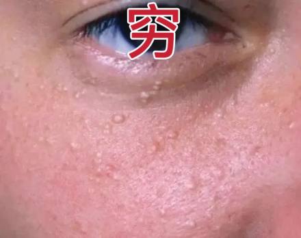 眼睛長(zhǎng)脂肪粒，是眼霜太營(yíng)養(yǎng)了？