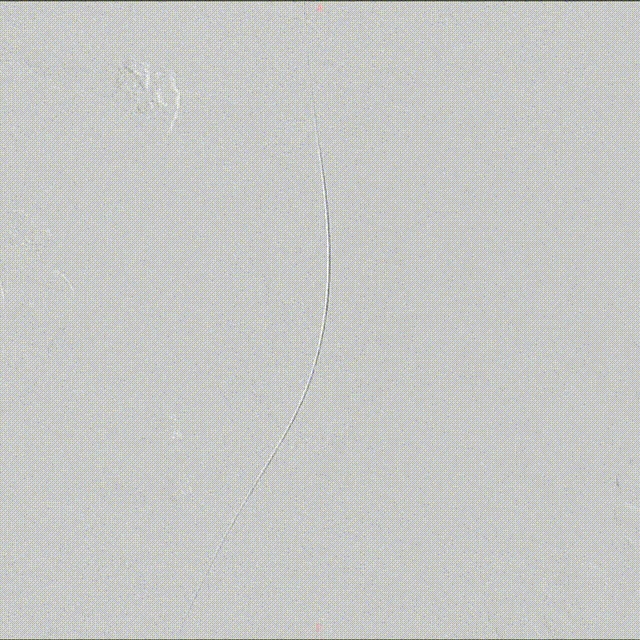 10月30日术前 00_00_00-00_00_30.gif