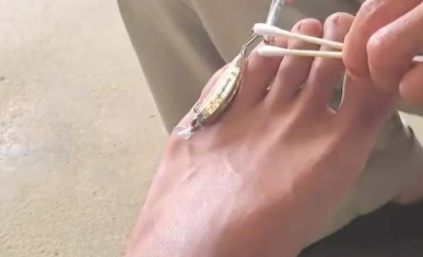 沒(méi)開(kāi)始就猜到結(jié)局了！桂林男子釣魚(yú)不慎把魚(yú)鉤勾到腳上，找醫(yī)生取鉤結(jié)果…