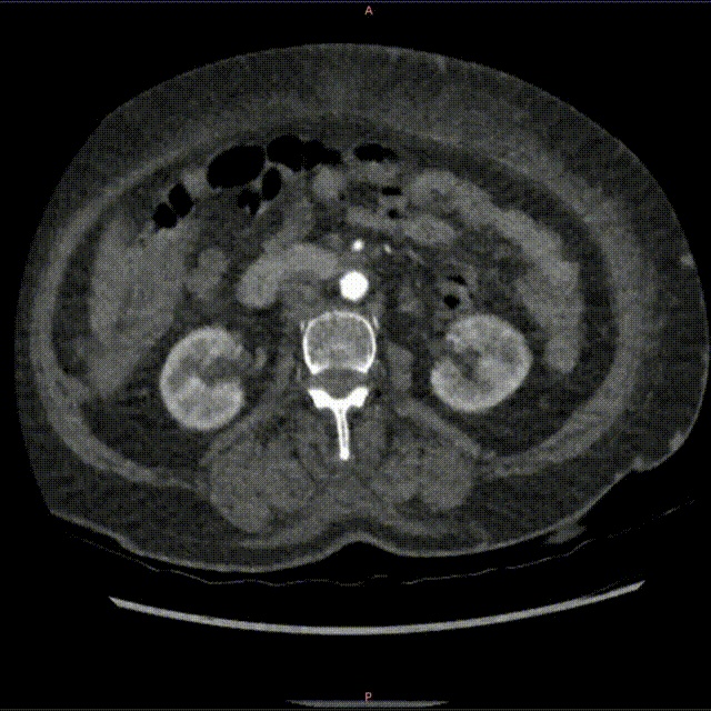 2 CTA可见左髂静脉受动脉压迫闭塞，同时左下肢静脉早显(1) 00_00_00-00_00_30.gif