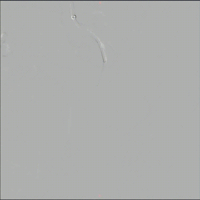 3 左髂内动脉多个分支动脉可见动静脉畸形 00_00_00-00_00_30.gif