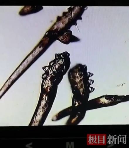 11歲女孩睫毛上發(fā)現(xiàn)10條螨蟲！醫(yī)生提醒
