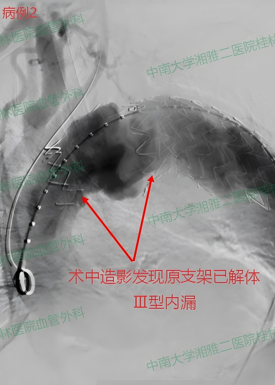 病例2-术中.png