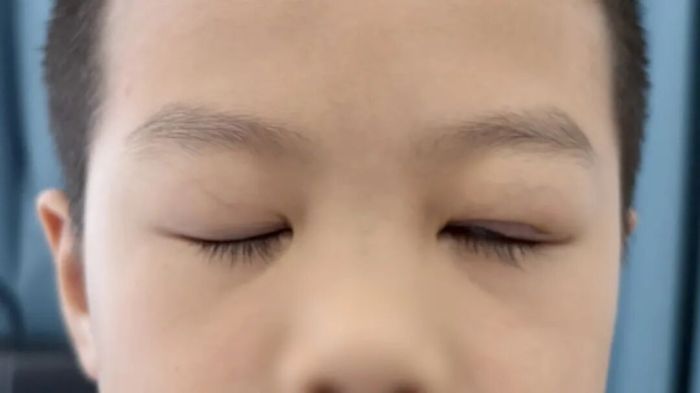 术后一周闭眼照.jpg