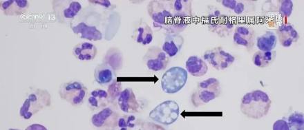 两名幼童感染“食脑虫”去世！紧急提醒→