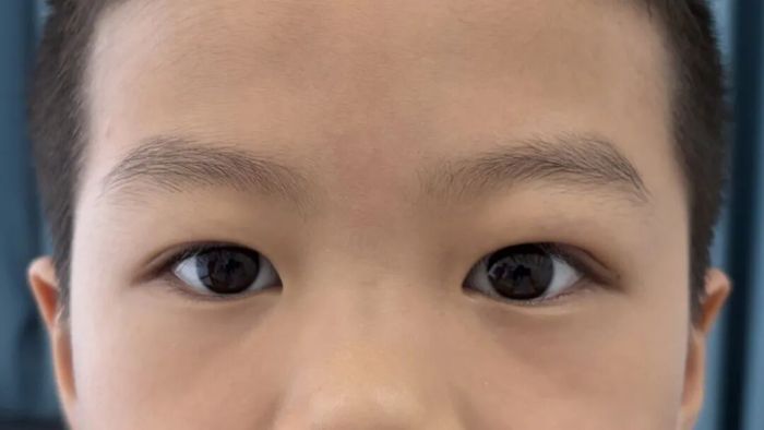 术后一周.jpg