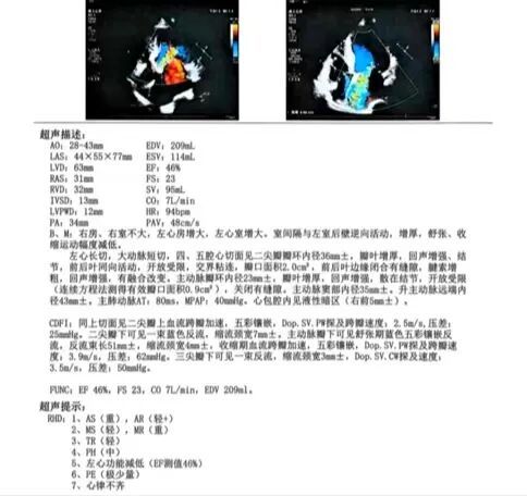 术前心脏彩超提示：心功能减低.jpg